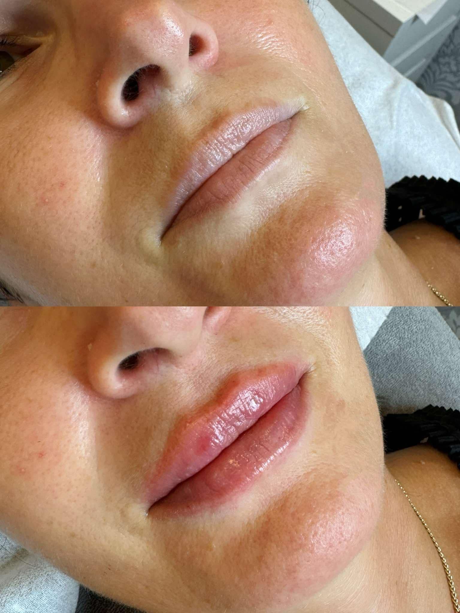 Efekt powiększania ust